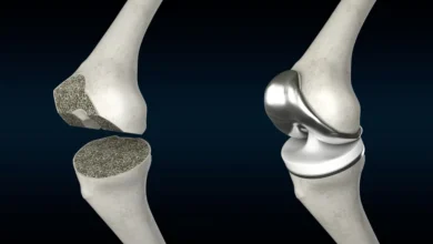 In recent years, knee replacement surgery Singapore has become increasingly popular due to the country's world-class healthcare system