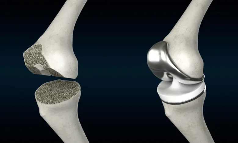 In recent years, knee replacement surgery Singapore has become increasingly popular due to the country's world-class healthcare system